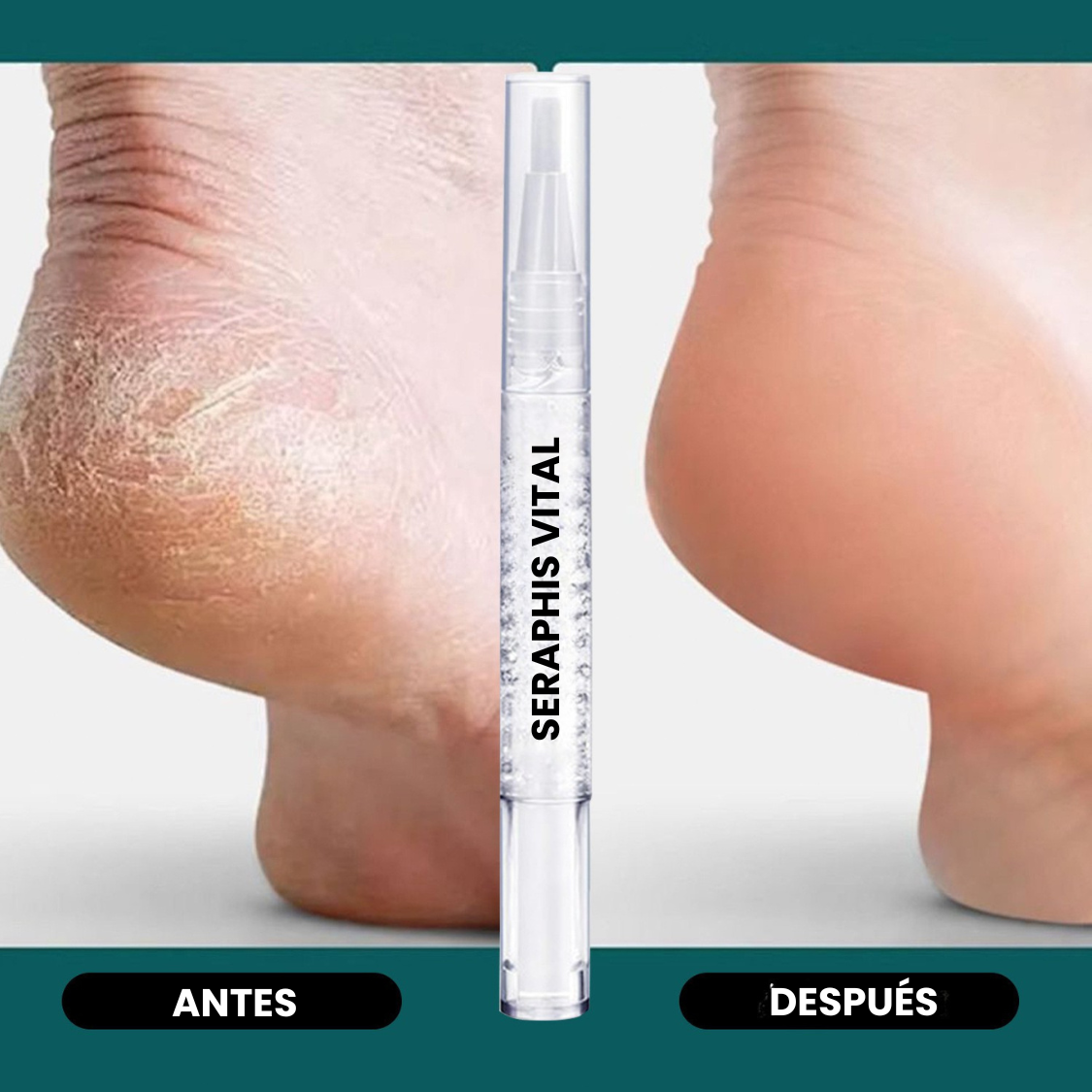 Seraphis Vital™ Bolígrafo anti hongos para pies